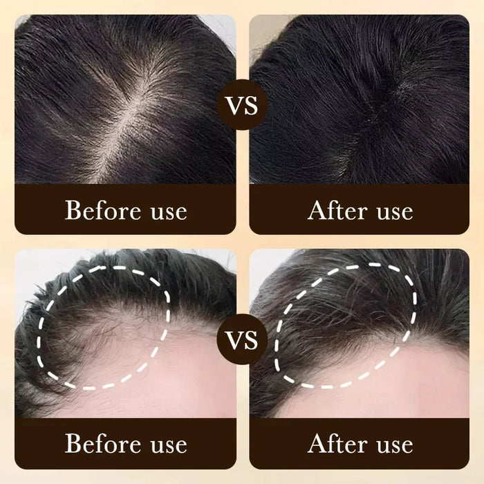 Esencia de crecimiento rápido del cabello, suero eficaz para la pérdida de cabello, reparación de la calvicie, herencia y productos para el cuidado de la caída del cabello seborreico posparto